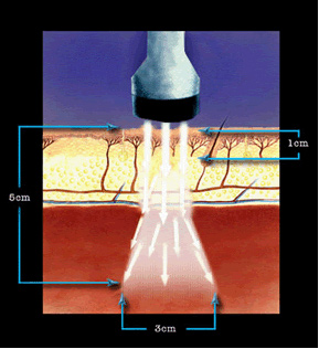 Cold Laser Therapy